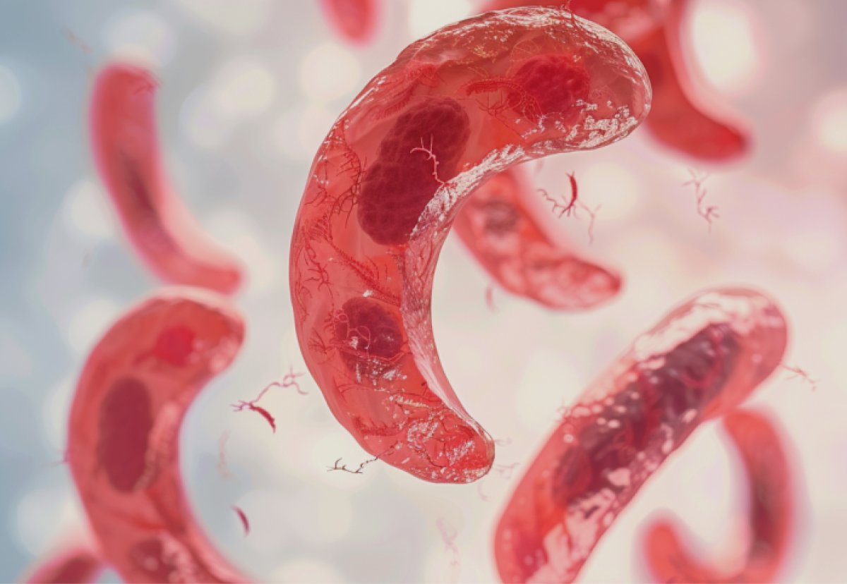 imagem-blog-anemia-falciforme-sintomas