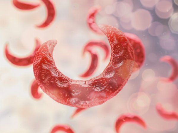 Anemia Falciforme